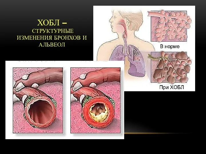 ХОБЛ – СТРУКТУРНЫЕ ИЗМЕНЕНИЯ БРОНХОВ И АЛЬВЕОЛ