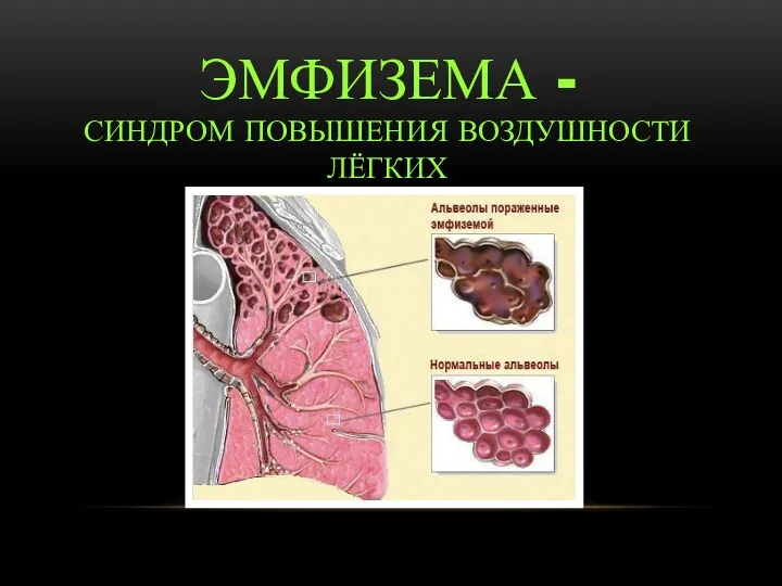 Матвеенко М.Е. ЭМФИЗЕМА - СИНДРОМ ПОВЫШЕНИЯ ВОЗДУШНОСТИ ЛЁГКИХ