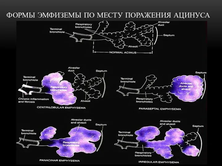 ФОРМЫ ЭМФИЗЕМЫ ПО МЕСТУ ПОРАЖЕНИЯ АЦИНУСА