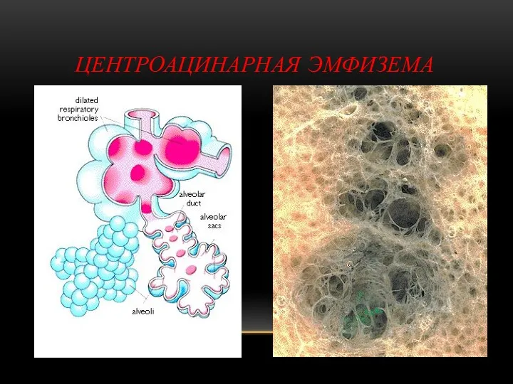 ЦЕНТРОАЦИНАРНАЯ ЭМФИЗЕМА