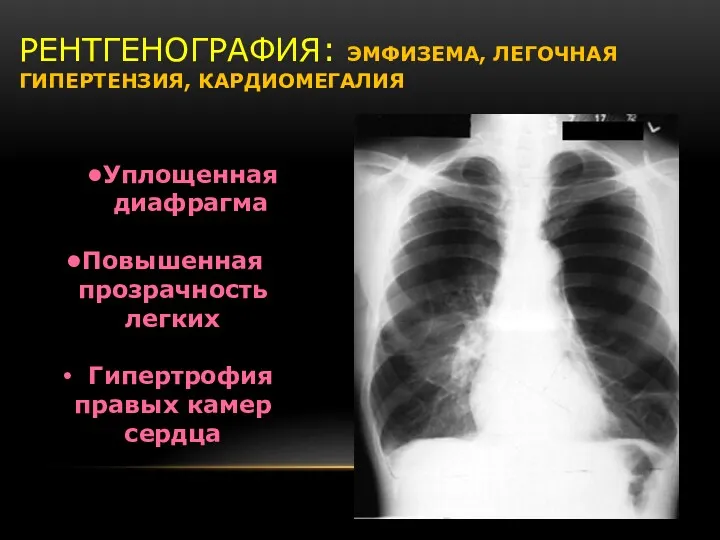 РЕНТГЕНОГРАФИЯ: ЭМФИЗЕМА, ЛЕГОЧНАЯ ГИПЕРТЕНЗИЯ, КАРДИОМЕГАЛИЯ Уплощенная диафрагма Повышенная прозрачность легких Гипертрофия правых камер сердца