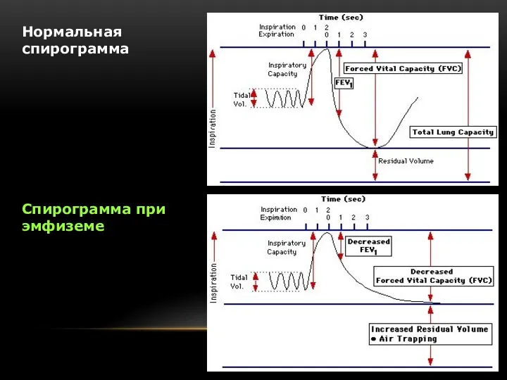 Нормальная спирограмма Спирограмма при эмфиземе