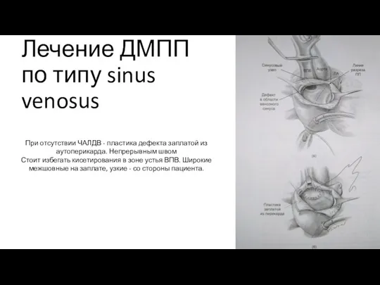 Лечение ДМПП по типу sinus venosus При отсутствии ЧАЛДВ -