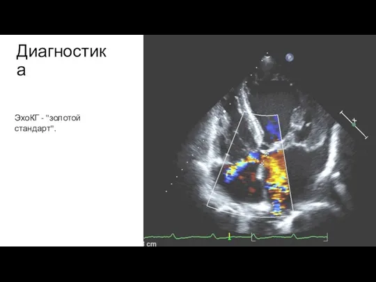 Диагностика ЭхоКГ - "золотой стандарт".
