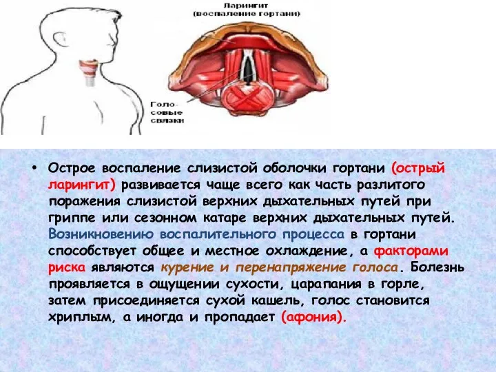 Острое воспаление слизистой оболочки гортани (острый ларингит) развивается чаще всего как часть разлитого