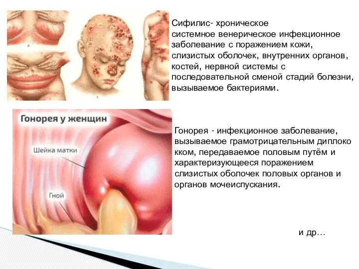 Сифилис- хроническое системное венерическое инфекционное заболевание с поражением кожи, слизистых