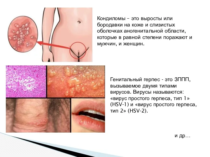 Кондиломы – это выросты или бородавки на коже и слизистых