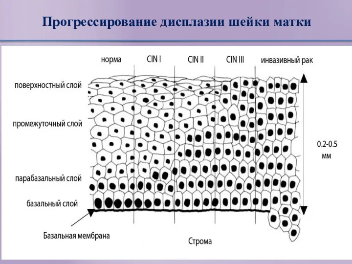 Прогрессирование дисплазии шейки матки