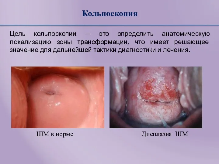 Кольпоскопия Цель кольпоскопии — это определить анатомическую локализацию зоны трансформации,