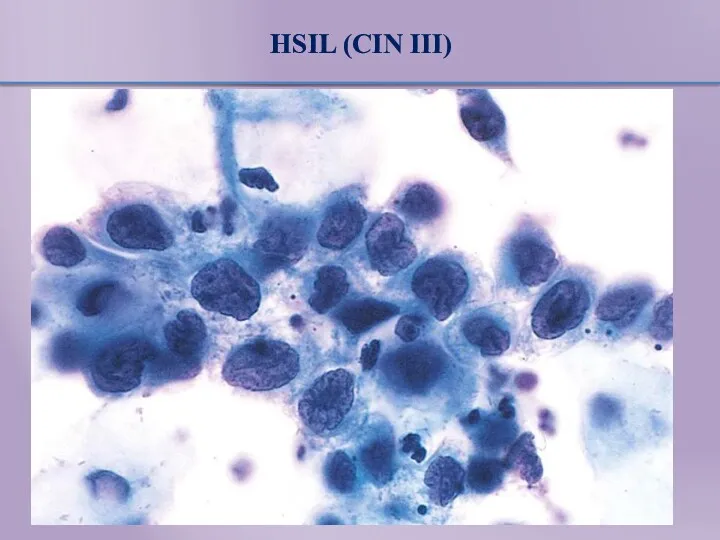 HSIL (CIN III)
