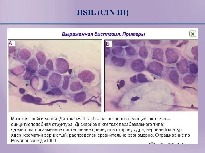 HSIL (CIN III)