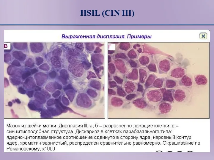 HSIL (CIN III)