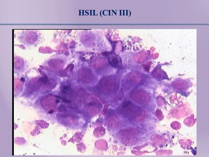 HSIL (CIN III)