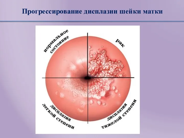 Прогрессирование дисплазии шейки матки