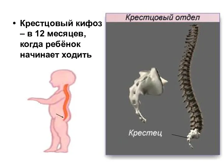 Крестцовый кифоз – в 12 месяцев, когда ребёнок начинает ходить