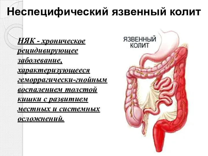 Неспецифический язвенный колит НЯК - хроническое рецидивирующее заболевание, характеризующееся геморрагически-гнойным воспалением толстой кишки