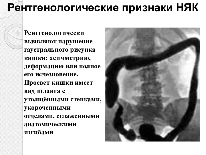 Рентгенологические признаки НЯК Рентгенологически выявляют нарушение гаустрального рисунка кишки: асимметрию, деформацию или полное