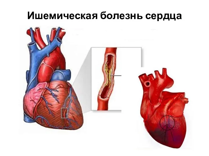 Ишемическая болезнь сердца