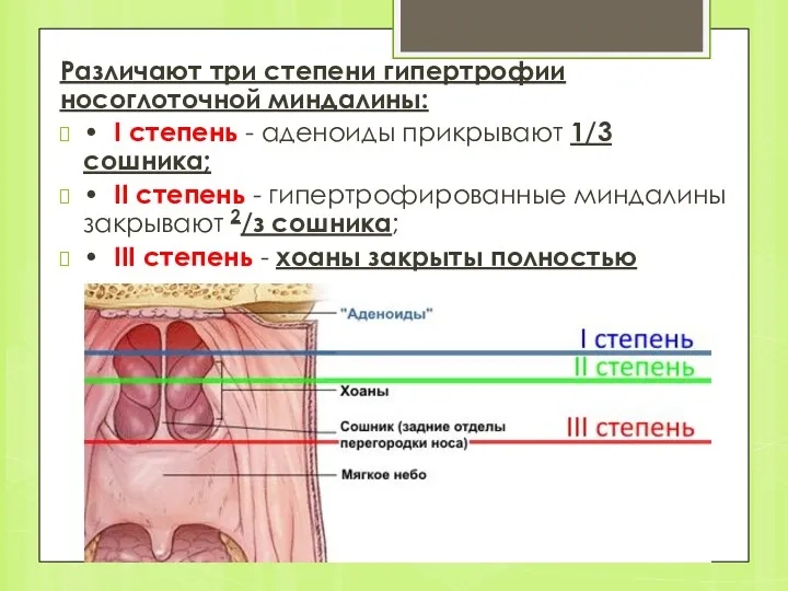 Различают три степени гипертрофии носоглоточной миндалины: • I степень -