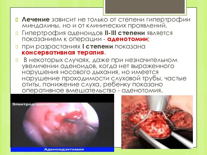 Лечение зависит не только от степени гипертрофии миндалины, но и