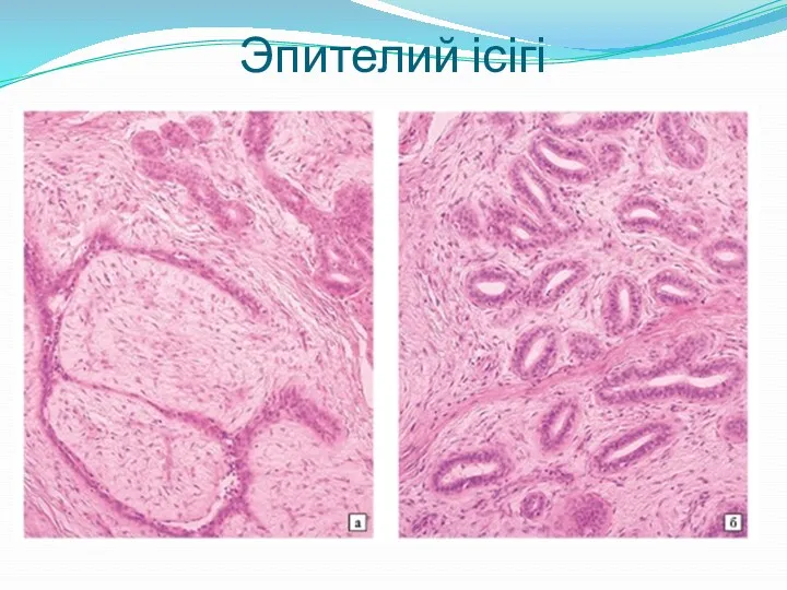 Эпителий ісігі