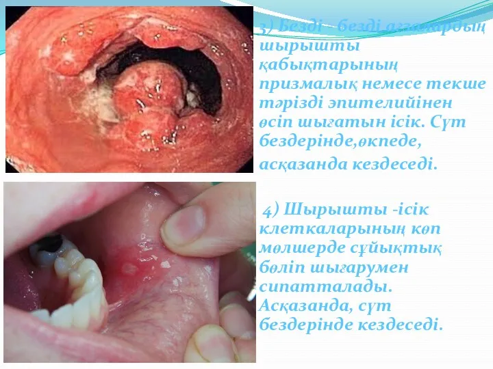 3) Безді - безді ағзалардың шырышты қабықтарының призмалық немесе текше тәрізді эпителийінен өсіп