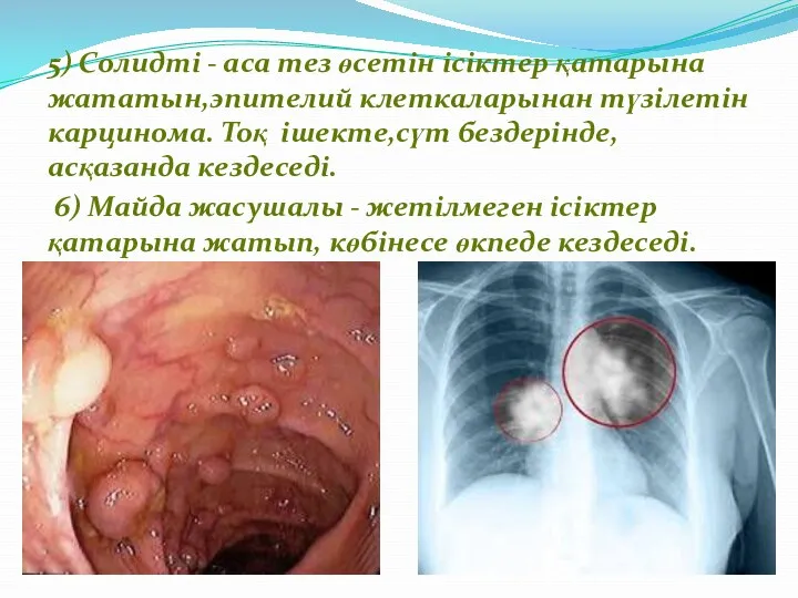 5) Солидті - аса тез өсетін ісіктер қатарына жататын,эпителий клеткаларынан