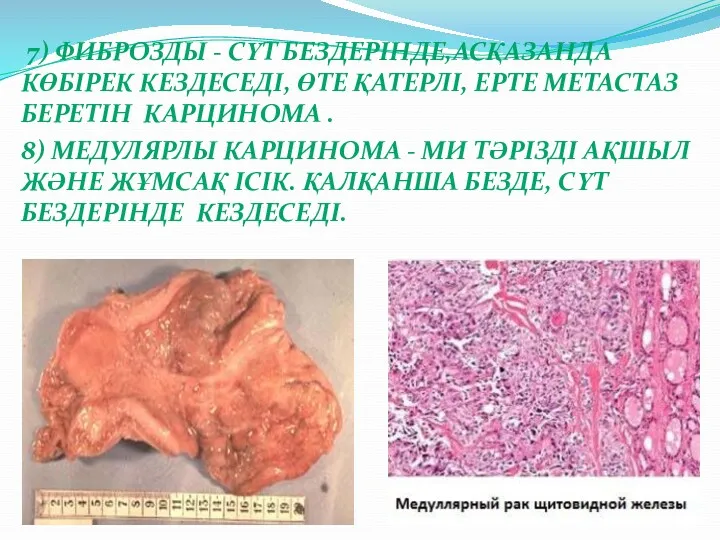 7) ФИБРОЗДЫ - СҮТ БЕЗДЕРІНДЕ,АСҚАЗАНДА КӨБІРЕК КЕЗДЕСЕДІ, ӨТЕ ҚАТЕРЛІ, ЕРТЕ МЕТАСТАЗ БЕРЕТІН КАРЦИНОМА