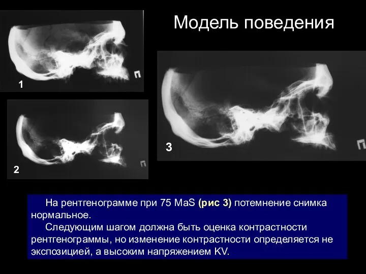 Модель поведения На рентгенограмме при 75 МаS (рис 3) потемнение снимка нормальное. Следующим