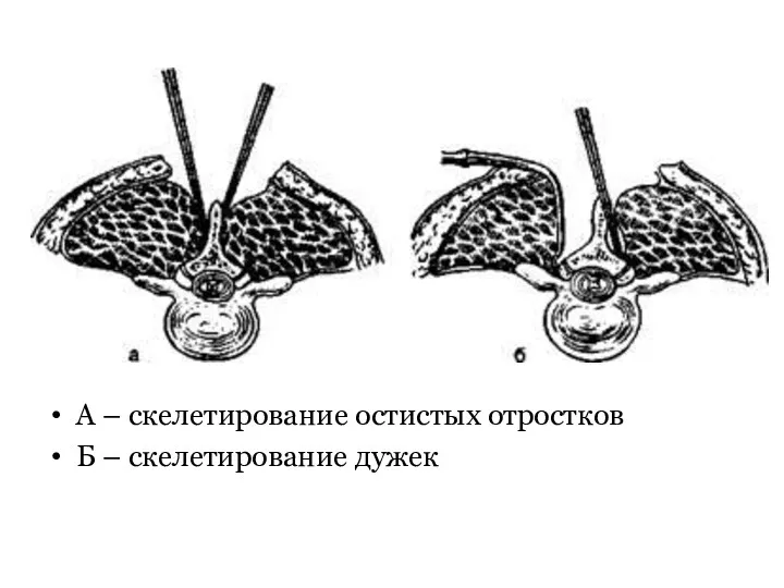 А – скелетирование остистых отростков Б – скелетирование дужек