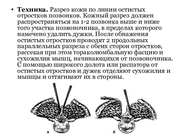 Техника. Разрез кожи по линии остистых отростков позвонков. Кожный разрез