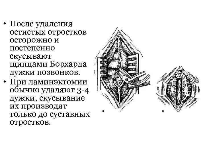 После удаления остистых отростков осторожно и постепенно скусывают щипцами Борхарда