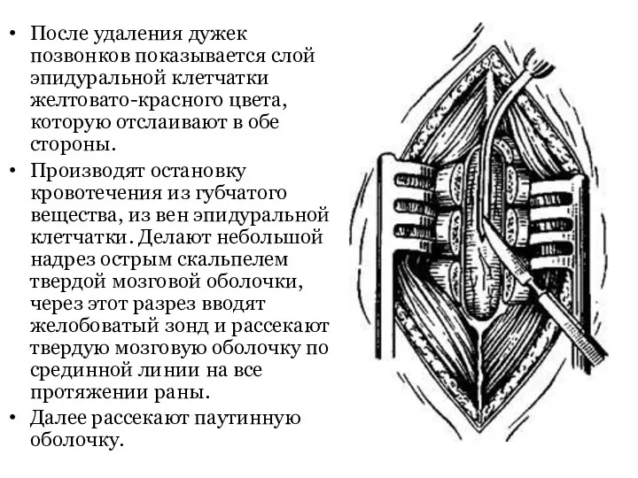 После удаления дужек позвонков показывается слой эпидуральной клетчатки желтовато-красного цвета,