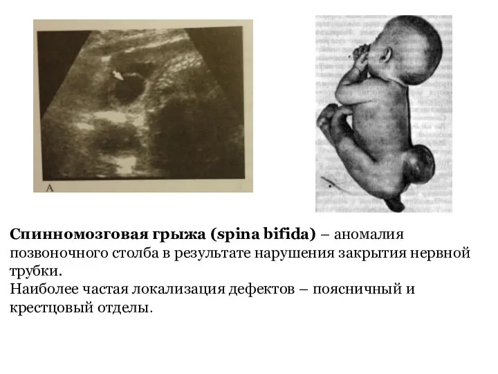 Спинномозговая грыжа (spina bifida) – аномалия позвоночного столба в результате