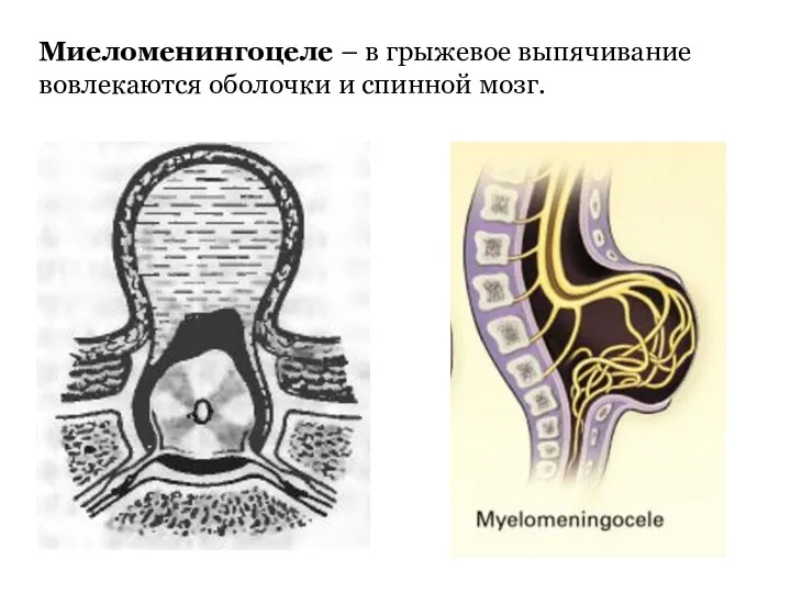 Миеломенингоцеле – в грыжевое выпячивание вовлекаются оболочки и спинной мозг.