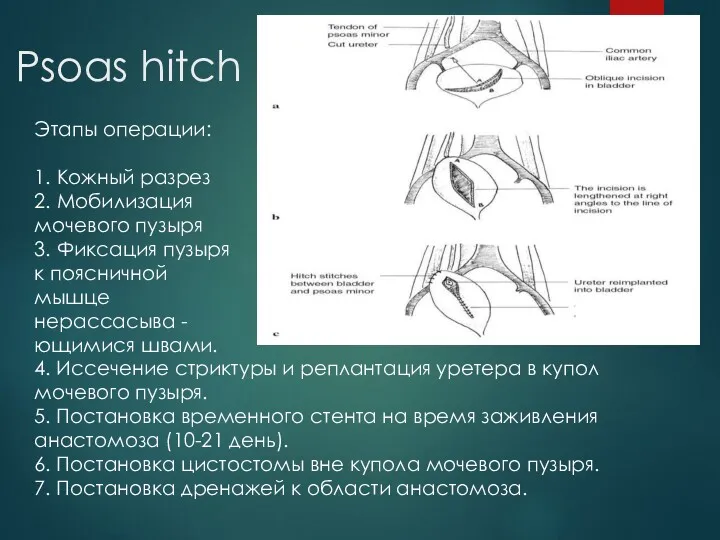 Psoas hitch Этапы операции: 1. Кожный разрез 2. Мобилизация мочевого