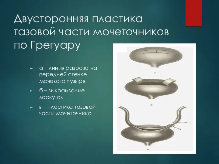 Двусторонняя пластика тазовой части мочеточников по Грегуару а – линия