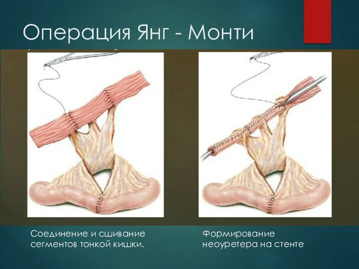 Операция Янг - Монти Соединение и сшивание сегментов тонкой кишки. Формирование неоуретера на стенте