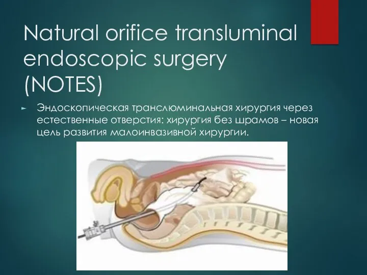 Natural orifice transluminal endoscopic surgery (NOTES) Эндоскопическая транслюминальная хирургия через