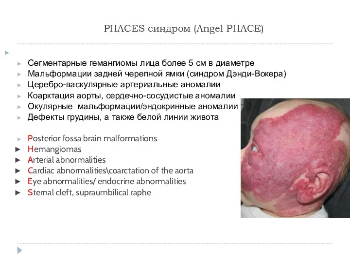 PHACES синдром (Angel PHACE) Сегментарные гемангиомы лица более 5 см