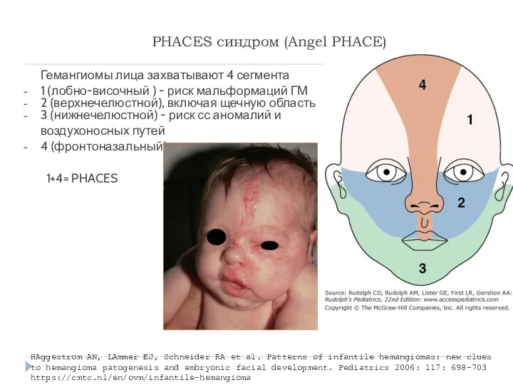 PHACES синдром (Angel PHACE) Гемангиомы лица захватывают 4 сегмента 1