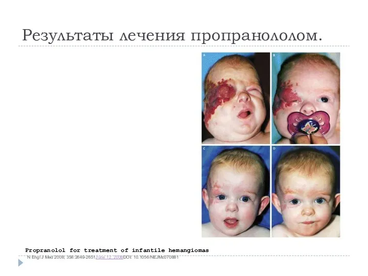 Результаты лечения пропранололом. Propranolol for treatment of infantile hemangiomas N