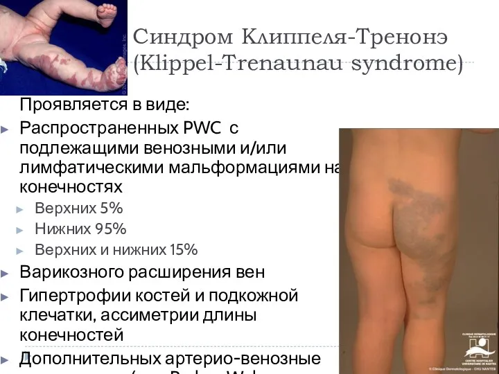 Синдром Клиппеля-Тренонэ (Klippel-Trenaunau syndrome) Проявляется в виде: Распространенных PWC с