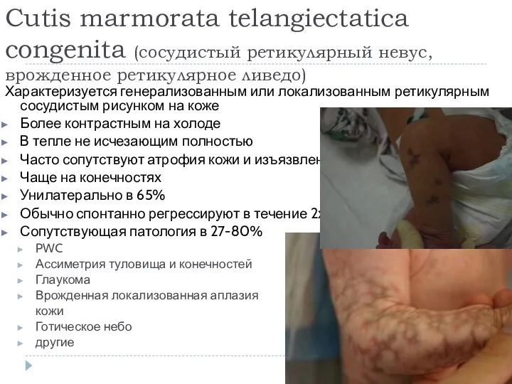 Cutis marmorata telangiectatica congenita (сосудистый ретикулярный невус, врожденное ретикулярное ливедо)