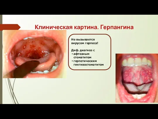 Клиническая картина. Герпангина Не вызывается вирусом герпеса! Диф. диагноз с афтозным стоматитом герпетическим гингивостоматитом