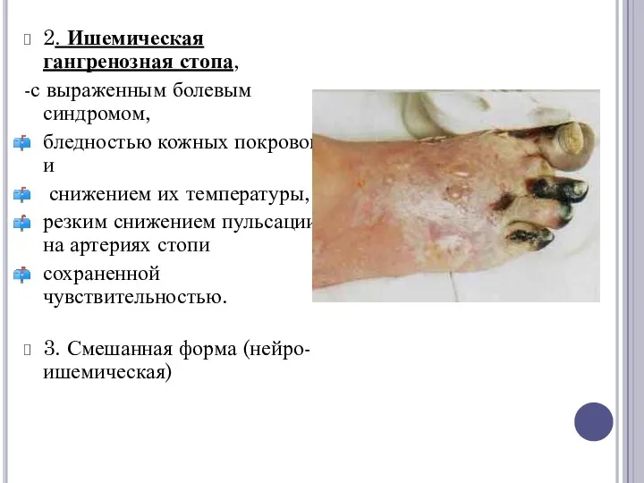 2. Ишемическая гангренозная стопа, -с выраженным болевым синдромом, бледностью кожных покровов и снижением