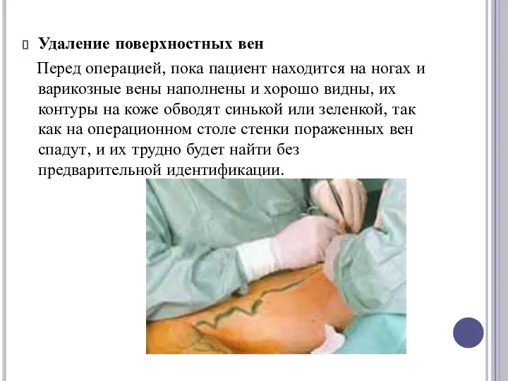 Удаление поверхностных вен Перед операцией, пока пациент находится на ногах и варикозные вены