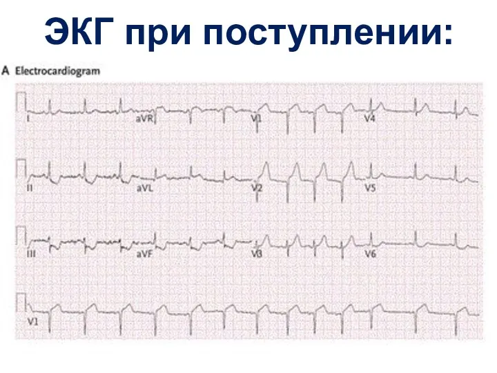 ЭКГ при поступлении: