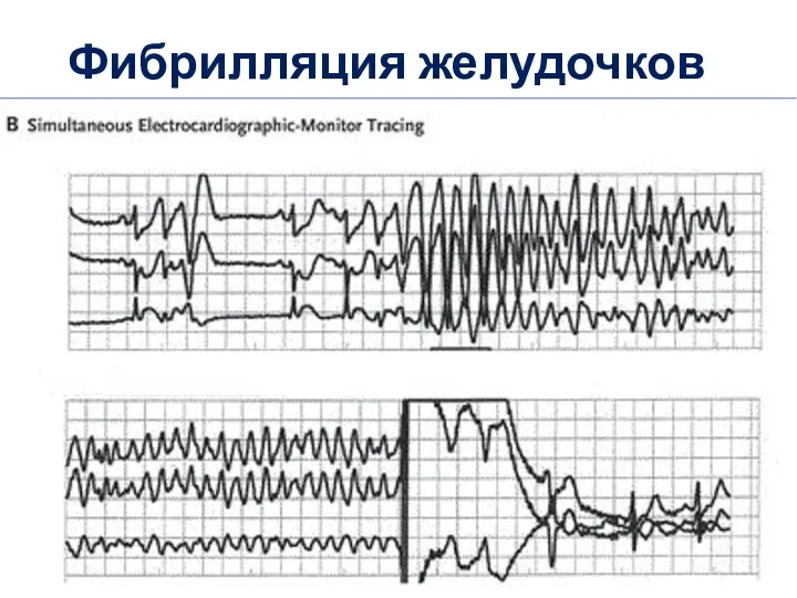 Фибрилляция желудочков