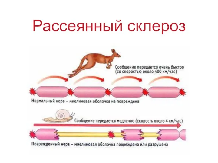 Рассеянный склероз